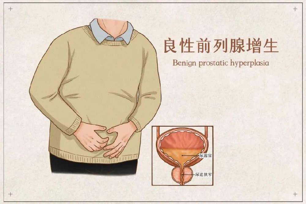男性前列腺肥大